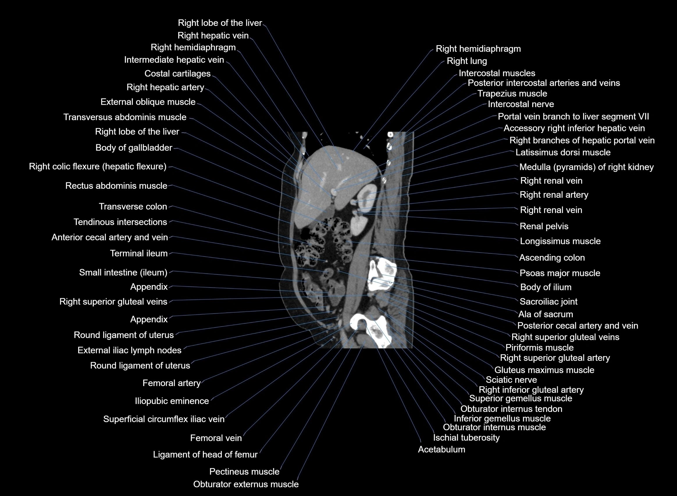 CT Abdomen sagittal cross sectional anatomy labelled radiology image -00077.webp